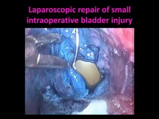 Laparoscopic repair of small
intraoperative bladder injury
 
