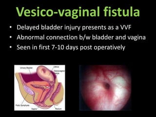 Vesico-vaginal fistula
• Delayed bladder injury presents as a VVF
• Abnormal connection b/w bladder and vagina
• Seen in first 7-10 days post operatively
 