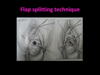 Flap splitting technique
 
