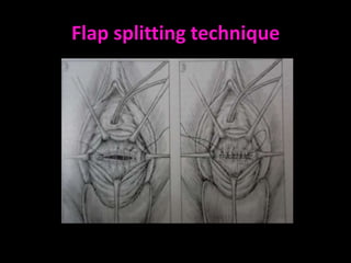 Flap splitting technique
 