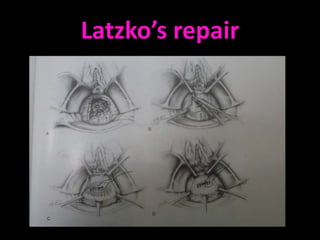 Latzko’s repair
 
