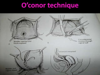 O’conor technique
 
