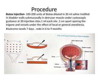 Bladder Botox in Urogynaecoloy ppt in india | PPTX