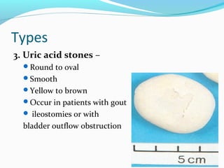 Types
3. Uric acid stones –
Round to oval
Smooth
Yellow to brown
Occur in patients with gout
 ileostomies or with
bladder outflow obstruction
 