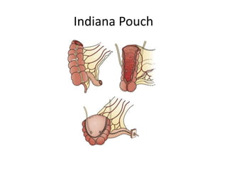 Bladder cancer | PPTX