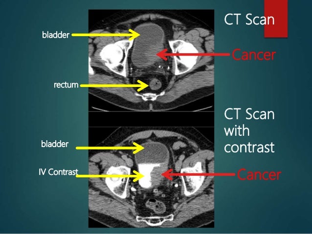 Bladder Cancer