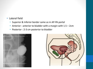 • Lateral field
• Superior & Inferior border same as in AP-PA portal
• Anterior : anterior to bladder with a margin with 1.5 – 2cm
• Posterior : 2-3 cm posterior to bladder
 