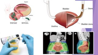 Bladder cancer and its management | PPTX