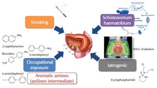 Smoking
Occupational
exposure
Schistosomum
haematobium
Iatrogenic
Aromatic amines
(anilines intermediate)
2-naphthylamine
4-nitrobiphenylBenzidine
4-aminobiphenyl
Pelvic irradiation
Cyclophosphamide
 