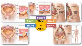 TNM
-
AJCC
Stage I
Stage II
Stage III
Stage IV
Stage 0
 