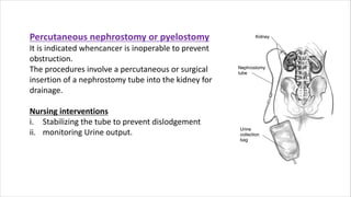 Bladder cancer | PDF
