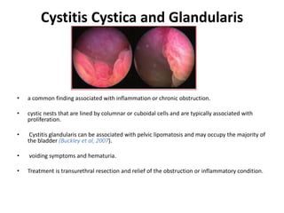 Cystitis Cystica and Glandularis
• a common finding associated with inflammation or chronic obstruction.
• cystic nests that are lined by columnar or cuboidal cells and are typically associated with
proliferation.
• Cystitis glandularis can be associated with pelvic lipomatosis and may occupy the majority of
the bladder (Buckley et al, 2007).
• voiding symptoms and hematuria.
• Treatment is transurethral resection and relief of the obstruction or inflammatory condition.
 