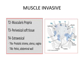 MUSCLE INVASIVE
 