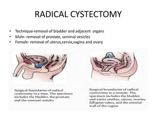 RADICAL CYSTECTOMY
• Technique-removal of bladder and adjacent organs
• Male- removal of prostate, seminal vesicles
• Female- removal of uterus,cervix,vagina and ovary
 