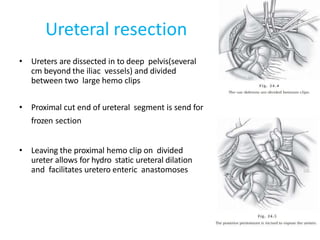 Ureteral resection
• Ureters are dissected in to deep pelvis(several
cm beyond the iliac vessels) and divided
between two large hemo clips
• Proximal cut end of ureteral segment is send for
frozen section
• Leaving the proximal hemo clip on divided
ureter allows for hydro static ureteral dilation
and facilitates uretero enteric anastomoses
 
