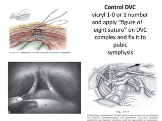 Control DVC
vicryl 1-0 or 1 number
and apply “figure of
eight suture” on DVC
complex and fix it to
pubic
symphysis
 