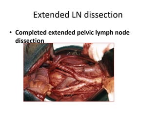 Extended LN dissection
• Completed extended pelvic lymph node
dissection
 