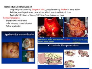 Ileal conduit urinary diversion
Originally described by Zaayer in 1911, popularised by Bricker in early 1950s
Reliable, easily performed procedure which has stood test of time
Typically 10-15 cm of ileum, 10-15cm from ileocaecal valve
Contraindications:
Short bowel syndrome
Inflammatory bowel disease
Pelvic irradiation
 