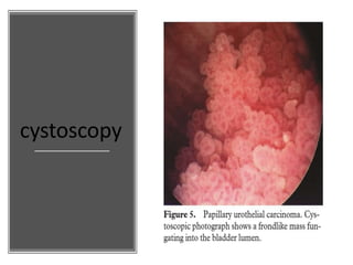 cystoscopy
 