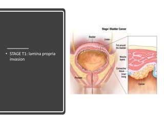 • STAGE T1: lamina propria
invasion
 