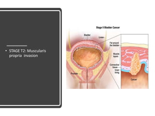 • STAGE T2: Muscularis
propria invasion
 