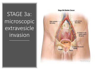 STAGE 3a:
microscopic
extravesicle
invasion
 