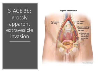 STAGE 3b:
grossly
apparent
extravesicle
invasion
 