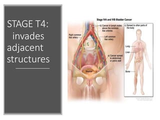 STAGE T4:
invades
adjacent
structures
 
