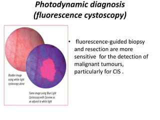 Photodynamic diagnosis
(fluorescence cystoscopy)
• fluorescence-guided biopsy
and resection are more
sensitive for the detection of
malignant tumours,
particularly for CIS .
 