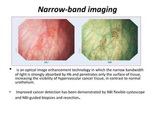 Narrow-band imaging
• is an optical image enhancement technology in which the narrow bandwidth
of light is strongly absorbed by Hb and penetrates only the surface of tissue,
increasing the visibility of hypervascular cancer tissue, in contrast to normal
urothelium.
• Improved cancer detection has been demonstrated by NBI flexible cystoscope
and NBI-guided biopsies and resection.
 