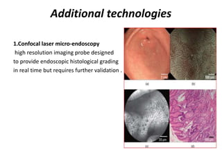Additional technologies
1.Confocal laser micro-endoscopy
high resolution imaging probe designed
to provide endoscopic histological grading
in real time but requires further validation .
 