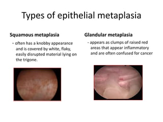 Types of epithelial metaplasia
Squamous metaplasia
- often has a knobby appearance
and is covered by white, flaky,
easily disrupted material lying on
the trigone.
Glandular metaplasia
- appears as clumps of raised red
areas that appear inflammatory
and are often confused for cancer
 