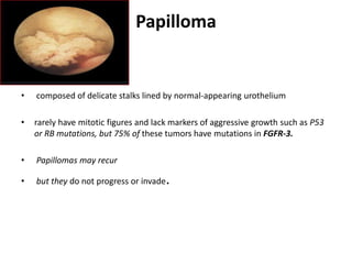 Papilloma
• composed of delicate stalks lined by normal-appearing urothelium
• rarely have mitotic figures and lack markers of aggressive growth such as P53
or RB mutations, but 75% of these tumors have mutations in FGFR-3.
• Papillomas may recur
• but they do not progress or invade.
 