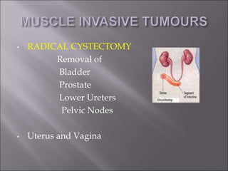 • RADICAL CYSTECTOMY
Removal of
Bladder
Prostate
Lower Ureters
Pelvic Nodes
• Uterus and Vagina
 