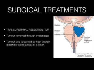 SURGICAL TREATMENTS
•

TRANSURETHRAL RESECTION (TUR)

•

Tumour removed through cystoscope

•

Tumour bed is burned by high energy
electricity using a heat or a laser

 