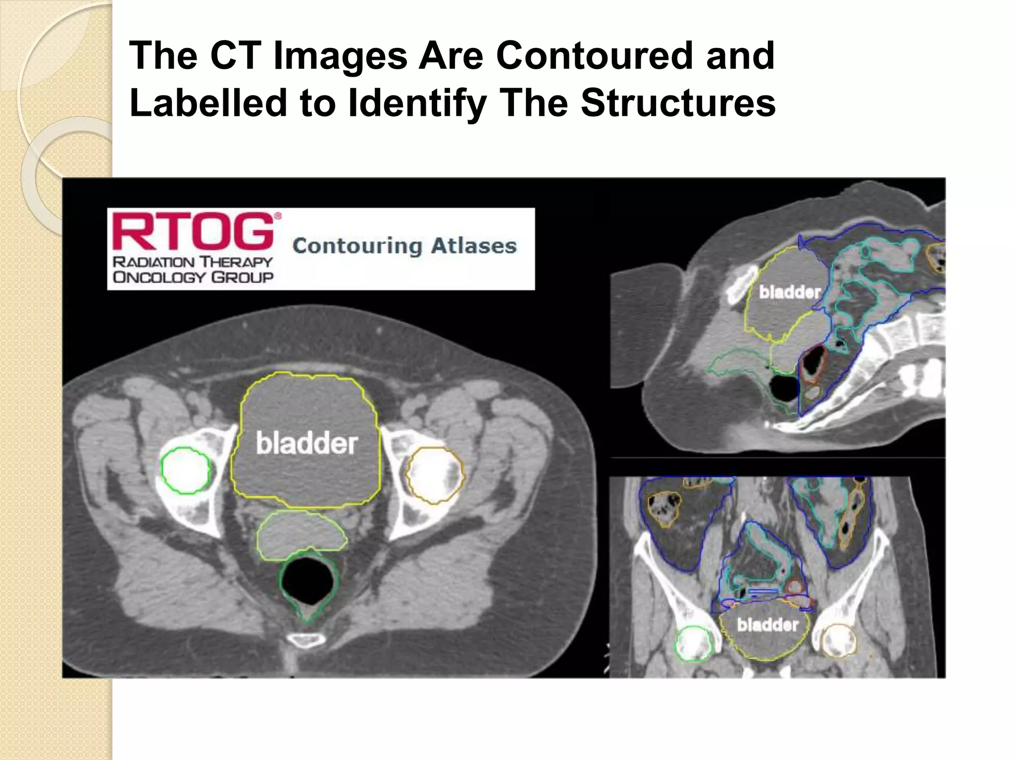 Radiation for the Treatment of Bladder Cancer | PPTX