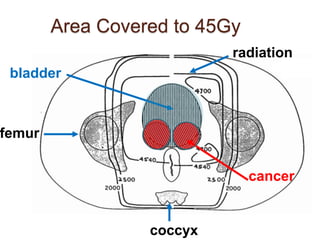 Radiation for the Treatment of Bladder Cancer | PPTX