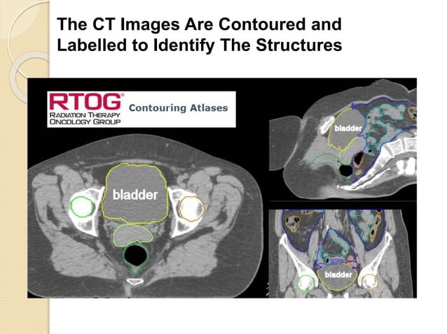 Radiation for the Treatment of Bladder Cancer | PPTX
