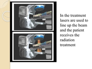 Radiation for the Treatment of Bladder Cancer | PPTX
