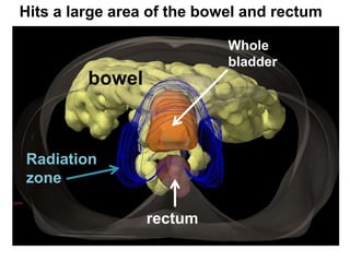 Radiation for the Treatment of Bladder Cancer | PPTX