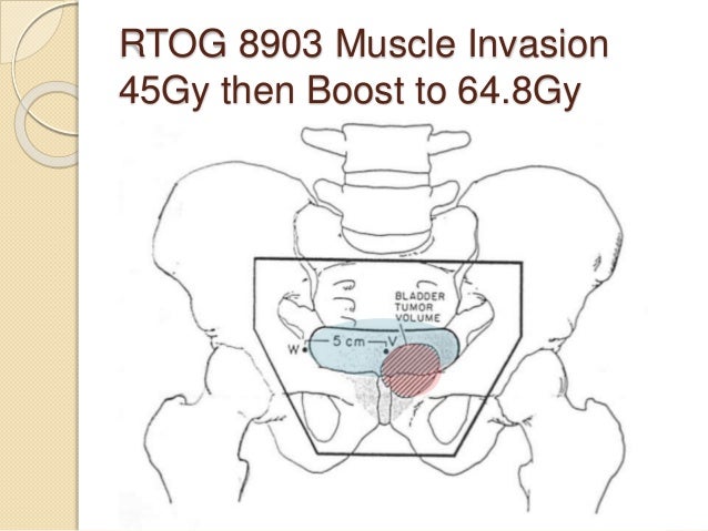 Radiation For The Treatment Of Bladder Cancer