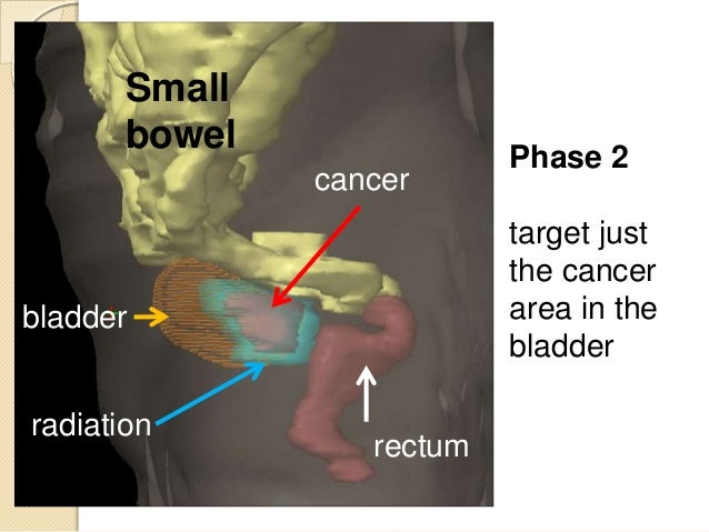 Radiation for the Treatment of Bladder Cancer
