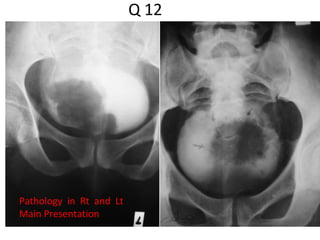 Q 12
Pathology in Rt and Lt
Main Presentation
 