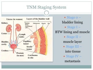 TNM Staging SystemStage 0 – bladder liningStage I – BTW lining and muscleStage II – muscle layerStage III – into tissueStage IV –metastasis