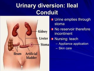 Urinary diversion: Ileal
Conduit
Urine empties through
stoma
No reservoir therefore
incontinent
Nursing: teach
– Appliance application
– Skin care

 