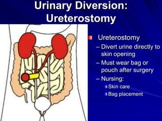 Urinary Diversion:
Ureterostomy
Ureterostomy
– Divert urine directly to
skin opening
– Must wear bag or
pouch after surgery
– Nursing:
Skin care
Bag placement

 