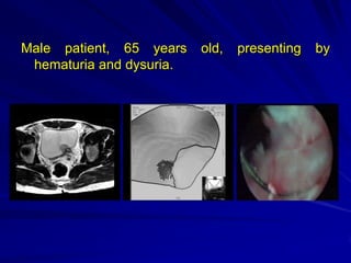 Male patient, 65 years
hematuria and dysuria.

old,

presenting

by

 