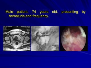 Male patient, 74 years old,
hematuria and frequency.

presenting

by

 