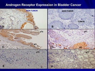 Androgen Receptor Expression in Bladder Cancer
NON-TUMOR

NON-TUMOR

TUMOR

A

A
B
pTa

pT1
pTa

NT

C

C
D
pT2

E

NT
pT3

F

 