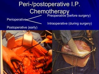 Peri-/postoperative I.P.
Chemotherapy

Preoperative (before surgery)

Perioperative

Intraoperative (during surgery)
Postoperative (early)

edh ICHS
Shenzhen 2004

 